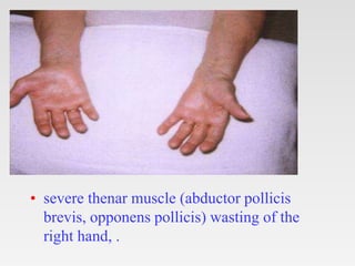 • severe thenar muscle (abductor pollicis
brevis, opponens pollicis) wasting of the
right hand, .
 