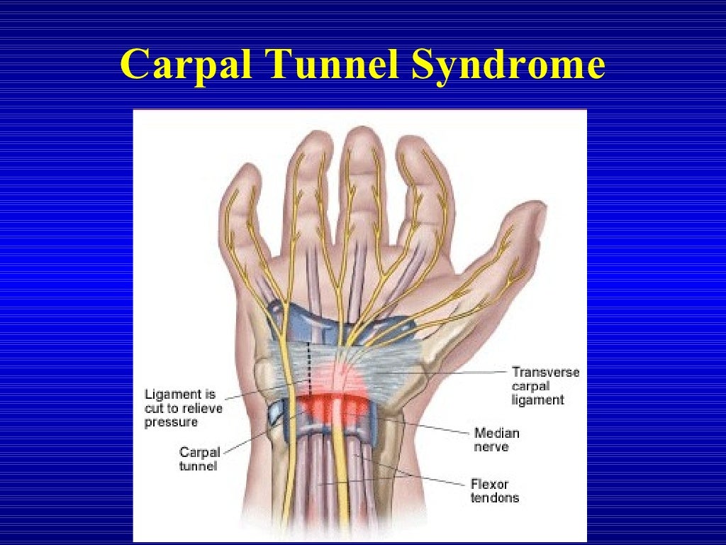 case presentation carpal tunnel syndrome