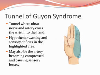 Carpal Tunnel Syndrome | PPTX