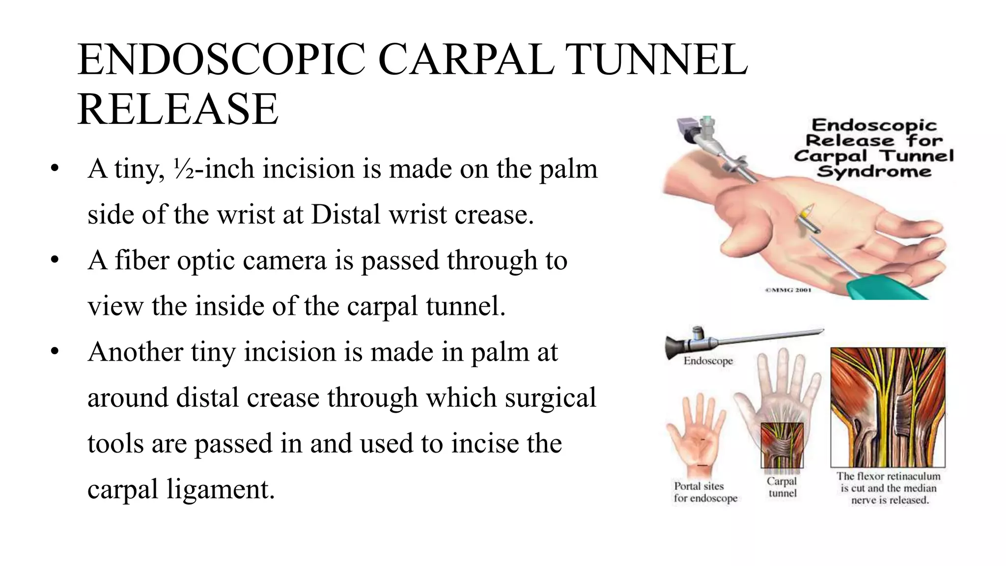 Carpel tunnel syndrome | PPTX