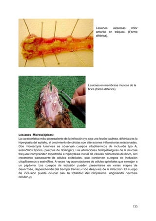 135
Lesiones ulcerosas color
amarillo en tráquea. (Forma
diftérica).
Lesiones en membrana mucosa de la
boca (forma diftérica).
Lesiones Microscópicas:
La característica más sobresaliente de la infección (ya sea una lesión cutánea, diftérica) es la
hiperplasia del epitelio, el crecimiento de células con alteraciones inflamatorias relacionadas.
Con microscopia luminosa se observan cuerpos citoplásmicos de inclusión tipo A,
eosinófilos típicos (cuerpos de Bollinger). Las alteraciones histopatológicas de la mucosa
traqueal comprenden hipertrofia e hiperplasia inicial de células productoras de moco, con
crecimiento subsecuente de células epiteliales, que contienen cuerpos de inclusión
citoplásmicos y eosinófilos. A veces hay acumulaciones de células epiteliales que semejan a
un papiloma. Los cuerpos de inclusión pueden presentarse en varias etapas de
desarrollo, dependiendo del tiempo transcurrido después de la infección. El cuerpo
de inclusión puede ocupar casi la totalidad del citoplasma, originando necrosis
celular. (1)
 