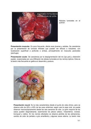 161
Nódulos tumorales en el
pulmón.
Presentación muscular. Es poco frecuente, afecta aves jóvenes y adultas. Se caracteriza
por la presentación de tumores linfoides que pueden ser difusos o nodulares, con
localización superficial a profunda o ambas, principalmente en músculos pectorales
(pechuga).
Presentación ocular. Se caracteriza por la despigmentación del iris (ojo gris) y distorsión
pupilar, ocasionadas por una infiltración de células tumorales en los nervios ópticos. Esta es
la lesión más frecuente en gallina en desarrollo y postura.
Presentación neural. Es la más característica desde el punto de vista clínico, pero se
observa sólo de 20% a 40% de las aves enfermas; según sea la cepa viral, se puede
observar macroscópicamente desde las seis semanas de vida. La gran mayoría de los
casos pueden diagnosticarse, examinando los plexos celiaco, mesentérico, craneal,
bronquial y ciático. En los nervios afectados se observa pérdida de las estriaciones,
cambio de color de perlado a gris amarillento y algunas veces edema. La lesión más
 