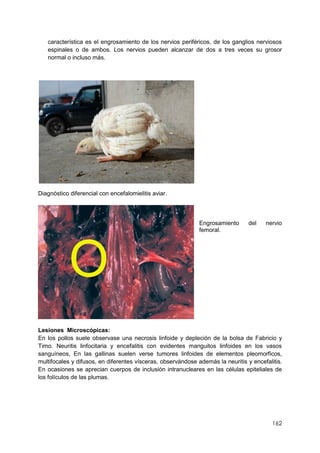 162
característica es el engrosamiento de los nervios periféricos, de los ganglios nerviosos
espinales o de ambos. Los nervios pueden alcanzar de dos a tres veces su grosor
normal o incluso más.
Diagnóstico diferencial con encefalomielitis aviar.
Engrosamiento del nervio
femoral.
Lesiones Microscópicas:
En los pollos suele observase una necrosis linfoide y depleción de la bolsa de Fabricio y
Timo. Neuritis linfocitaria y encefalitis con evidentes manguitos linfoides en los vasos
sanguíneos, En las gallinas suelen verse tumores linfoides de elementos pleomorficos,
multifocales y difusos, en diferentes vísceras, observándose además la neuritis y encefalitis.
En ocasiones se aprecian cuerpos de inclusión intranucleares en las células epiteliales de
los folículos de las plumas.
 