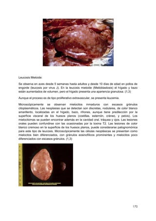170
Leucosis Mieloide:
Se observa en aves desde 5 semanas hasta adultos y desde 10 días de edad en pollos de
engorde (leucosis por virus J). En la leucosis mieloide (Mieloblastosis) el hígado y bazo
están aumentados de volumen, pero el hígado presenta una apariencia granulosa. (1,3)
Aunque el proceso es de tipo proliferativo extravascular, se presenta leucemia.
Microscópicamente se observan mielocitos inmaduros con escasos gránulos
citoplasmáticos. Las neoplasias que se detectan son discretas, nodulares, de color blanco
amarillento, localizadas en el hígado, bazo, riñones, aunque tiene predilección por la
superficie visceral de los huesos planos (costillas, esternón, cráneo, y pelvis). Los
mielocitomas se pueden encontrar además en la cavidad oral, tráquea y ojos. Las lesiones
orales pueden confundirse con las ocasionadas por la toxina T2. Las lesiones de color
blanco cremoso en la superficie de los huesos planos, puede considerarse patognomónica
para este tipo de leucosis. Microscópicamente las células neoplásicas se presentan como
mielocitos bien diferenciados, con gránulos eosinofílicos prominentes y mielocitos poco
diferenciados con escasos gránulos. (1,3)
 