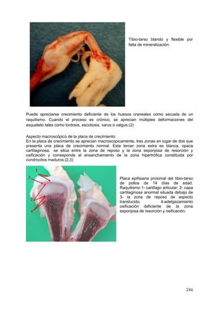246
Tibio-tarso blando y flexible por
falta de mineralización.
Puede apreciarse crecimiento deficiente de los huesos craneales como secuela de un
raquitismo. Cuando el proceso es crónico, se aprecian múltiples deformaciones del
esqueleto tales como lordosis, escoliosis, varus o valgus.(2)
Aspecto macroscópico de la placa de crecimiento:
En la placa de crecimiento se aprecian macroscopicamente, tres zonas en lugar de dos que
presenta una placa de crecimiento normal. Esta tercer zona extra es blanca, opaca
cartilaginosa, se sitúa entre la zona de reposo y la zona esponjosa de resorción y
osificación y corresponde al ensanchamiento de la zona hipertrófica constituida por
condrocitos maduros.(2,3)
Placa epifisiaria proximal del tibio-tarso
de pollos de 14 días de edad.
Raquitismo 1- cartílago articular; 2- capa
cartilaginosa anormal situada debajo de
3- la zona de reposo de aspecto
translucido, 4-adelgazamiento
osificación deficiente de la zona
esponjosa de resorción y osificación.
 