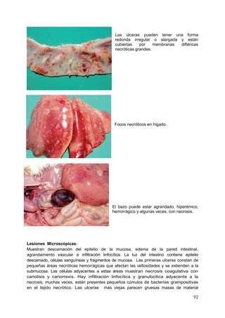 92
Las úlceras pueden tener una forma
redonda irregular o alargada y están
cubiertas por membranas diftéricas
necróticas grandes.
Focos necróticos en hígado.
El bazo puede estar agrandado, hiperémico,
hemorrágico y algunas veces, con necrosis.
Lesiones Microscópicas:
Muestran descamación del epitelio de la mucosa, edema de la pared intestinal,
agrandamiento vascular e infiltración linfocítica. La luz del intestino contiene epitelio
descamado, células sanguíneas y fragmentos de mucosa. Las primeras ulceras constan de
pequeñas áreas necróticas hemorrágicas que afectan las vellosidades y se extienden a la
submucosa. Las células adyacentes a estas áreas muestran necrosis coagulativa con
cariolisis y cariorrexis. Hay infiltración linfocítica y granulocitica adyacente a la
necrosis, muchas veces, están presentes pequeños cúmulos de bacterias grampositivas
en el tejido necrótico. Las ulceras más viejas parecen gruesas masas de material
 