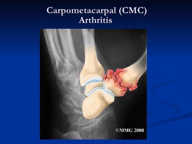 Carpometacarpal ( C)