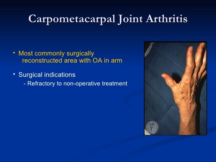 Cmc joint arthritis support
