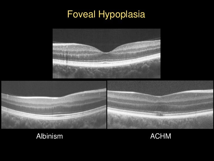  Affected individuals are thought to have no cone function (though see Nishiguchi, et al. 2005).