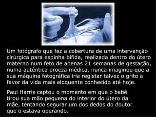 Um fotógrafo que fez a cobertura de uma intervenção cirúrgica para espinha bífida, realizada dentro do útero materno num feto de apenas 21 semanas de gestação, numa autêntica proeza médica, nunca imaginou que a sua máquina fotográfica iria registar talvez o grito a favor da vida mais eloquente conhecido até hoje. Paul Harris captou o momento em que o bebê tirou sua mão pequena do interior do útero da mãe, tentando segurar um dos dedos do doutor que o estava operando. 