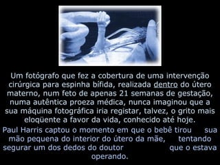 Um fotógrafo que fez a cobertura de uma intervenção
cirúrgica para espinha bífida, realizada dentro do útero
materno, num feto de apenas 21 semanas de gestação,
numa autêntica proeza médica, nunca imaginou que a
sua máquina fotográfica iria registar, talvez, o grito mais
eloqüente a favor da vida, conhecido até hoje.
Paul Harris captou o momento em que o bebê tirou
sua
mão pequena do interior do útero da mãe,
tentando
segurar um dos dedos do doutor
que o estava
operando.

 