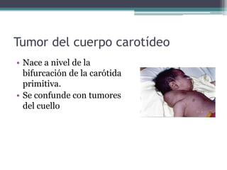 Tumor del cuerpo carotídeo
• Nace a nivel de la
bifurcación de la carótida
primitiva.
• Se confunde con tumores
del cuello
 