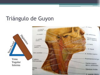 Triángulo de Guyon
Vena
Yugular
Interna
 