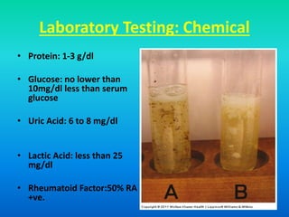 Laboratory Testing: Chemical
• Protein: 1-3 g/dl
• Glucose: no lower than
10mg/dl less than serum
glucose
• Uric Acid: 6 to 8 mg/dl
• Lactic Acid: less than 25
mg/dl
• Rheumatoid Factor:50% RA
+ve.
 