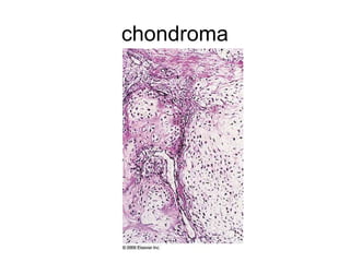 Cartilage forming tumors | PPT