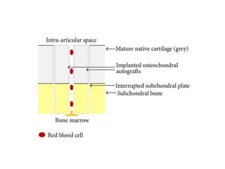 Management of Cartilage injuries | PPTX