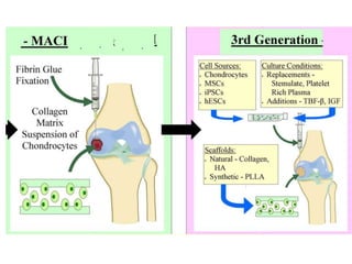Management of Cartilage injuries | PPTX
