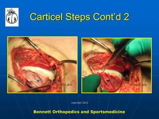Carticel Steps Cont’d 2 
Bennett Orthopedics and Sportsmedicine 
copyright 2012  