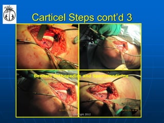 Carticel Steps cont’d 3 
Bennett Orthopedics and Sportsmedicine 
copyright 2012  