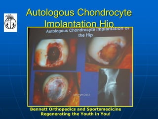 Autologous Chondrocyte Implantation Hip 
Bennett Orthopedics and Sportsmedicine Regenerating the Youth in You! 
copyright 2012  