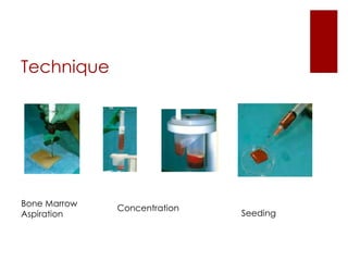 Technique

Bone Marrow
Aspiration

Concentration

Seeding

 