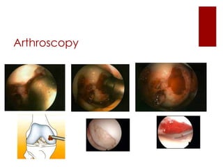 Arthroscopy

 