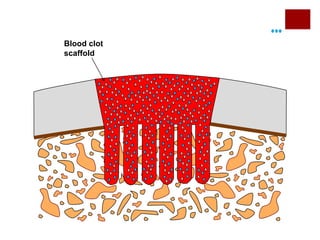 Blood clot
scaffold

 