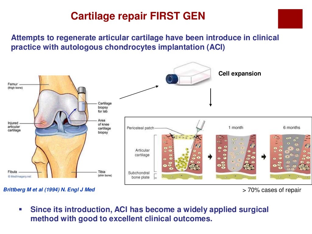 Cartilage Repair using Stem cell & Orthobiologics