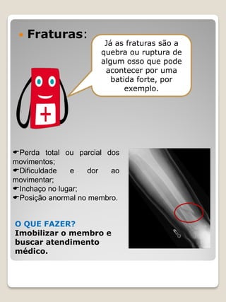 Fraturas: 
Já as fraturas são a quebra ou ruptura de algum osso que pode acontecer por uma batida forte, por exemplo. 
O QUE FAZER? Imobilizar o membro e buscar atendimento médico. 
Perda total ou parcial dos movimentos; Dificuldade e dor ao movimentar; Inchaço no lugar; Posição anormal no membro.  