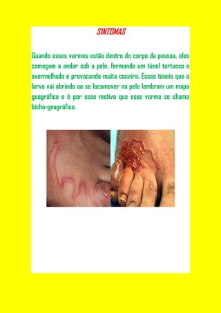 SINTOMAS

Quando esses vermes estão dentro do corpo da pessoa, eles
começam a andar sob a pele, formando um túnel tortuoso e
avermelhado e provocando muita coceira. Esses túneis que a
larva vai abrindo ao se locomover na pele lembram um mapa
geográfico e é por esse motivo que esse verme se chama
bicho-geográfico.
 