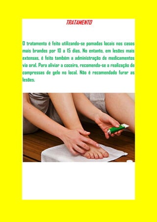 TRATAMENTO


O tratamento é feito utilizando-se pomadas locais nos casos
mais brandos por 10 a 15 dias. No entanto, em lesões mais
extensas, é feito também a administração de medicamentos
via oral. Para aliviar a coceira, recomenda-se a realização de
compressas de gelo no local. Não é recomendado furar as
lesões.
 