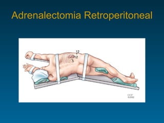 Adrenalectomia Retroperitoneal 
