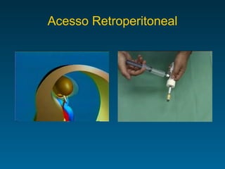 Acesso Retroperitoneal 