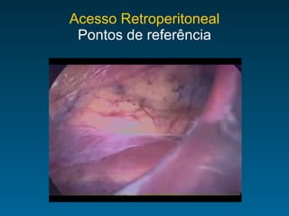 Acesso Retroperitoneal Pontos de referência 