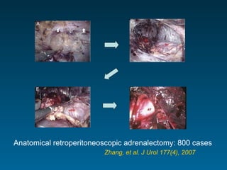 Anatomical retroperitoneoscopic adrenalectomy: 800 cases  Zhang, et al. J Urol 177(4), 2007 