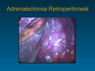 Adrenalectomia Retroperitoneal 