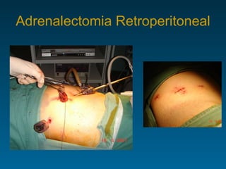 Adrenalectomia Retroperitoneal 