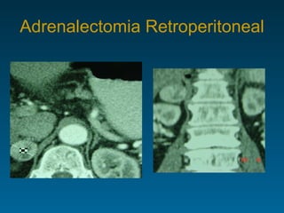 Adrenalectomia Retroperitoneal 