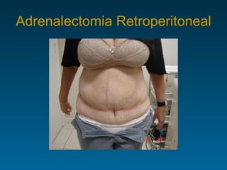 Adrenalectomia Retroperitoneal 