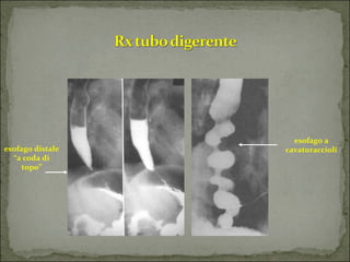 esofago a 
esofago distale    cavaturaccioli
  “a coda di 
     topo”
 