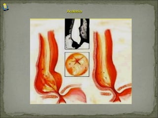 Acalasia
 