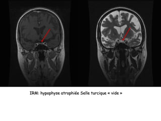 IRM: hypophyse atrophiée Selle turcique « vide »
 