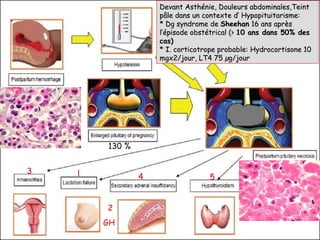 Devant Asthénie, Douleurs abdominales,Teint
                    pâle dans un contexte d’ Hypopituitarisme:
                    * Dg syndrome de Sheehan 16 ans après
                    l’épisode obstétrical (> 10 ans dans 50% des
                    cas)
                    * I. corticotrope probable: Hydrocortisone 10
                    mgx2/jour, LT4 75 µg/jour




        130 %


3   1           4                 5


        2
        GH
 