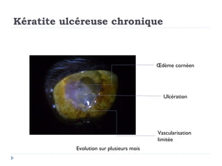 Kératite ulcéreuse chronique



                                          Œdème cornéen




                                            Ulcération




                                          Vascularisation
                                          limitée
           Evolution sur plusieurs mois
 