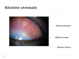Kératite stromale




                    Néovascularisation




                    Œdème cornéen




                     Absence d’ulcère
 