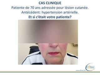 CAS CLINIQUE
Patiente de 70 ans adressée pour lésion cutanée.
Antécédent: hypertension artérielle.
Et si c’était votre patiente?
 