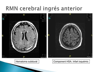 Cas clnic meningitis en immunodeprimits