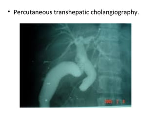 • Percutaneous transhepatic cholangiography.
 