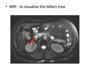 • MRI : to visualize the biliary tree.
 