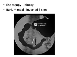 • Endoscopy + biopsy
• Barium meal : inverted 3 sign
 